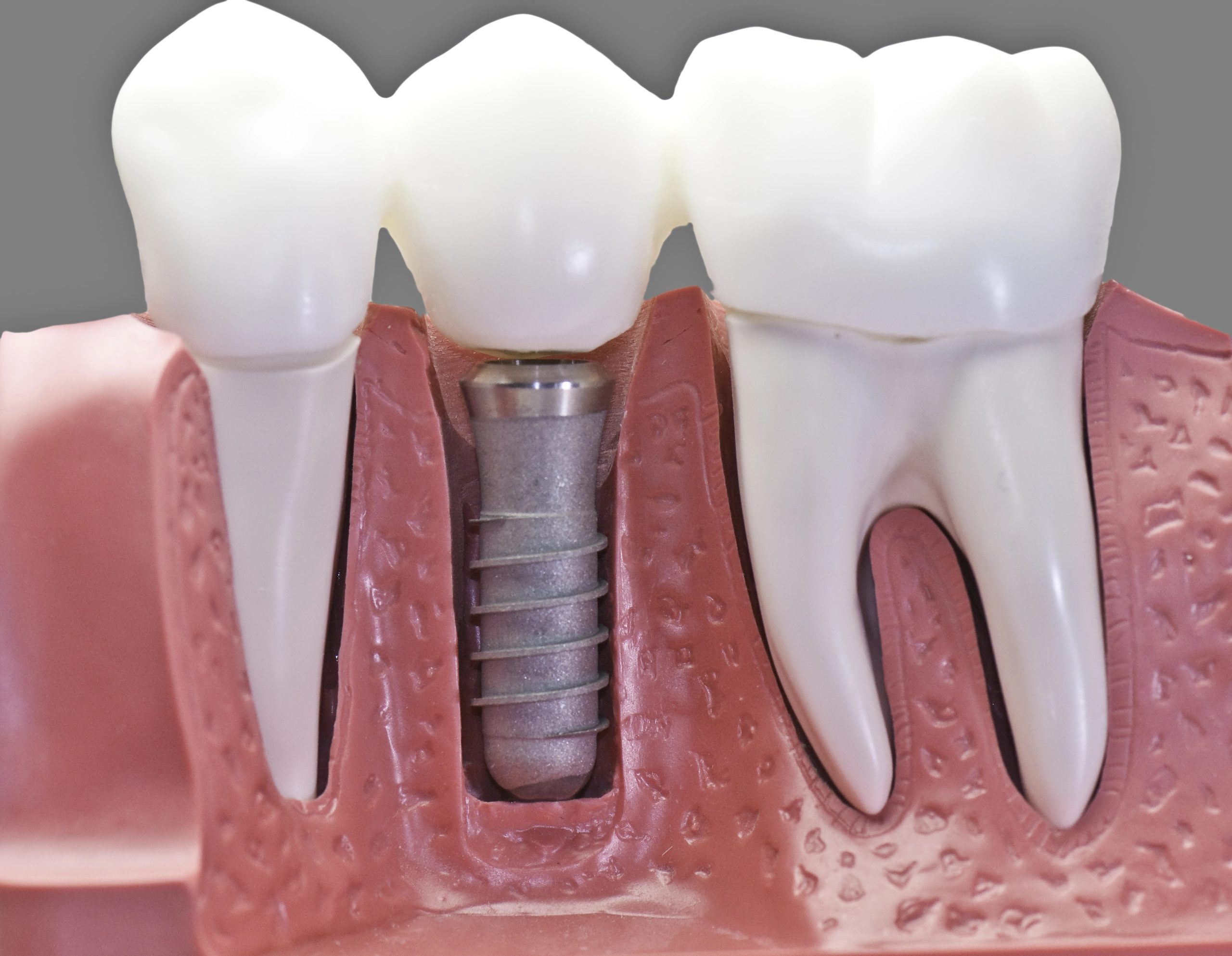 Single Tooth Implant Replacement: A Natural and Lasting Fix