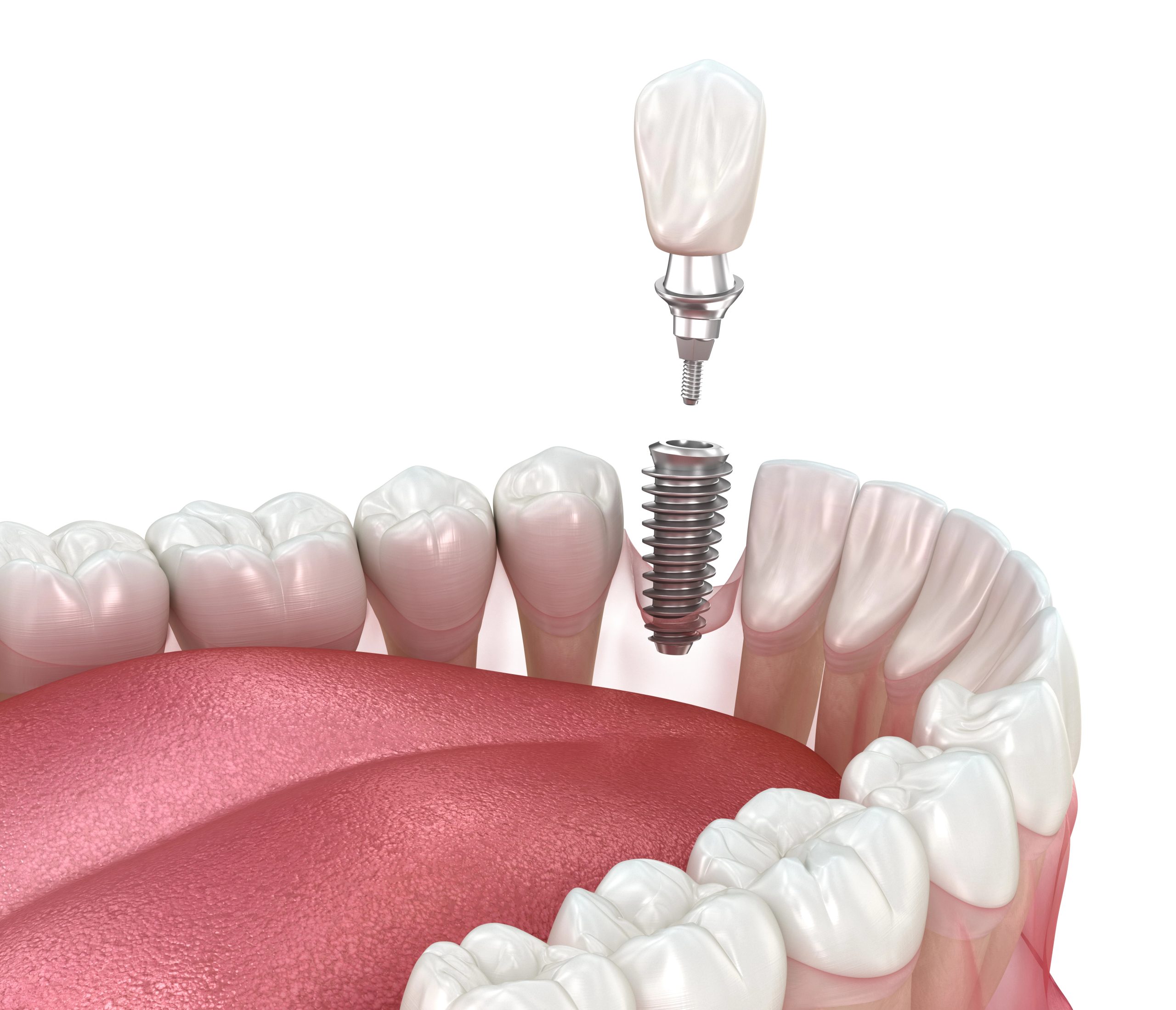 Dental Implant for Missing Teeth: A Permanent, Seamless Solution