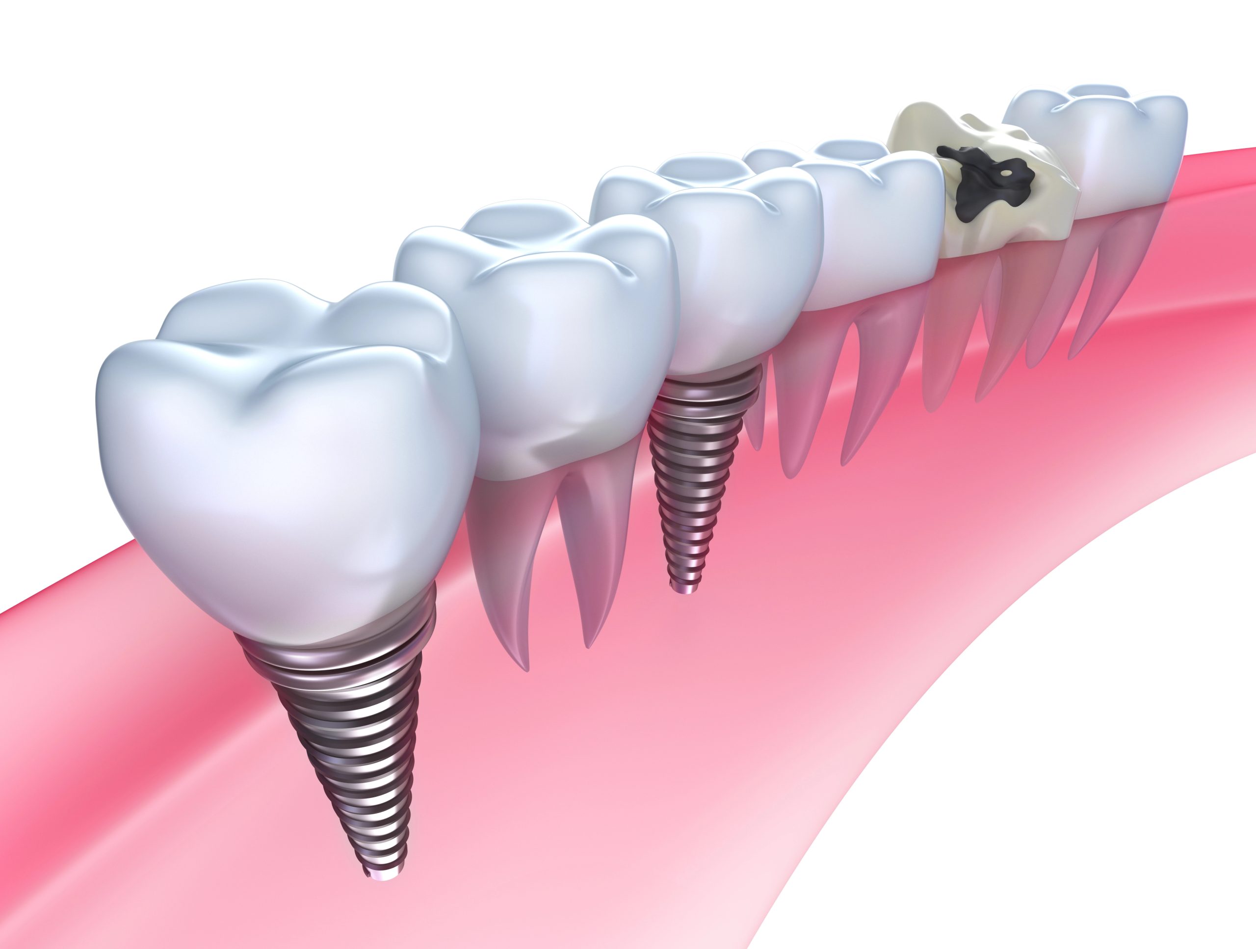 Full Mouth Dental Implants: Complete Smile Transformation