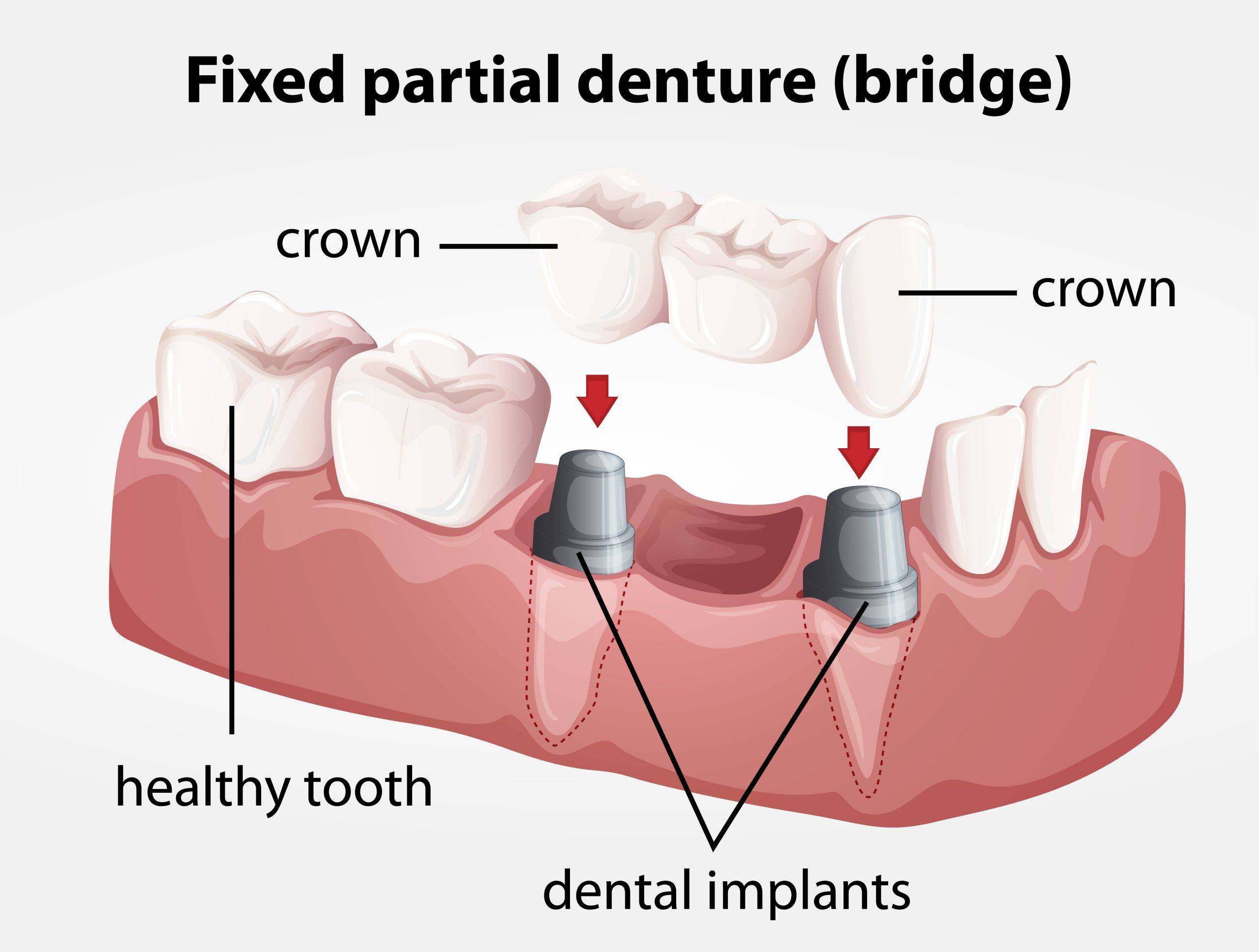 Dental Implant Near Me: Restore Your Smile with Local Experts
