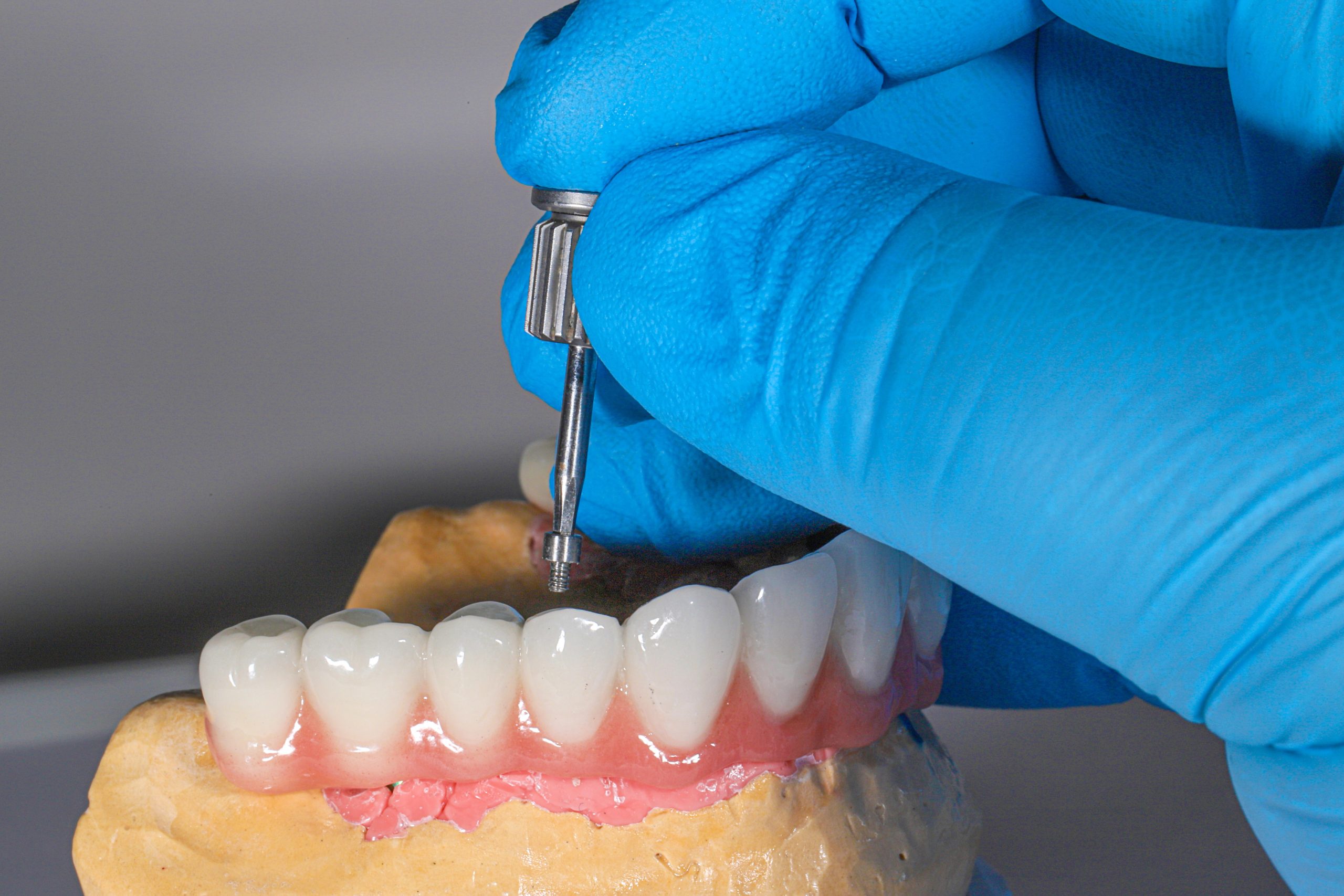 Bone Grafting Success Rate in Dentistry: What Research Reveals