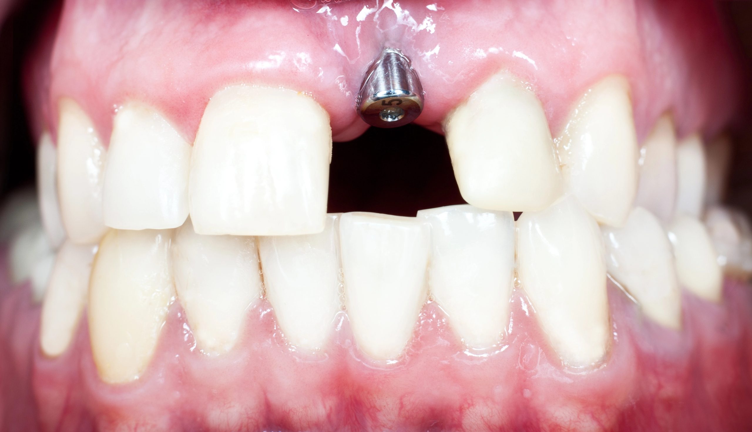 Full Mouth All on 4 Implants Benefits: Restoring Function and Confidence
