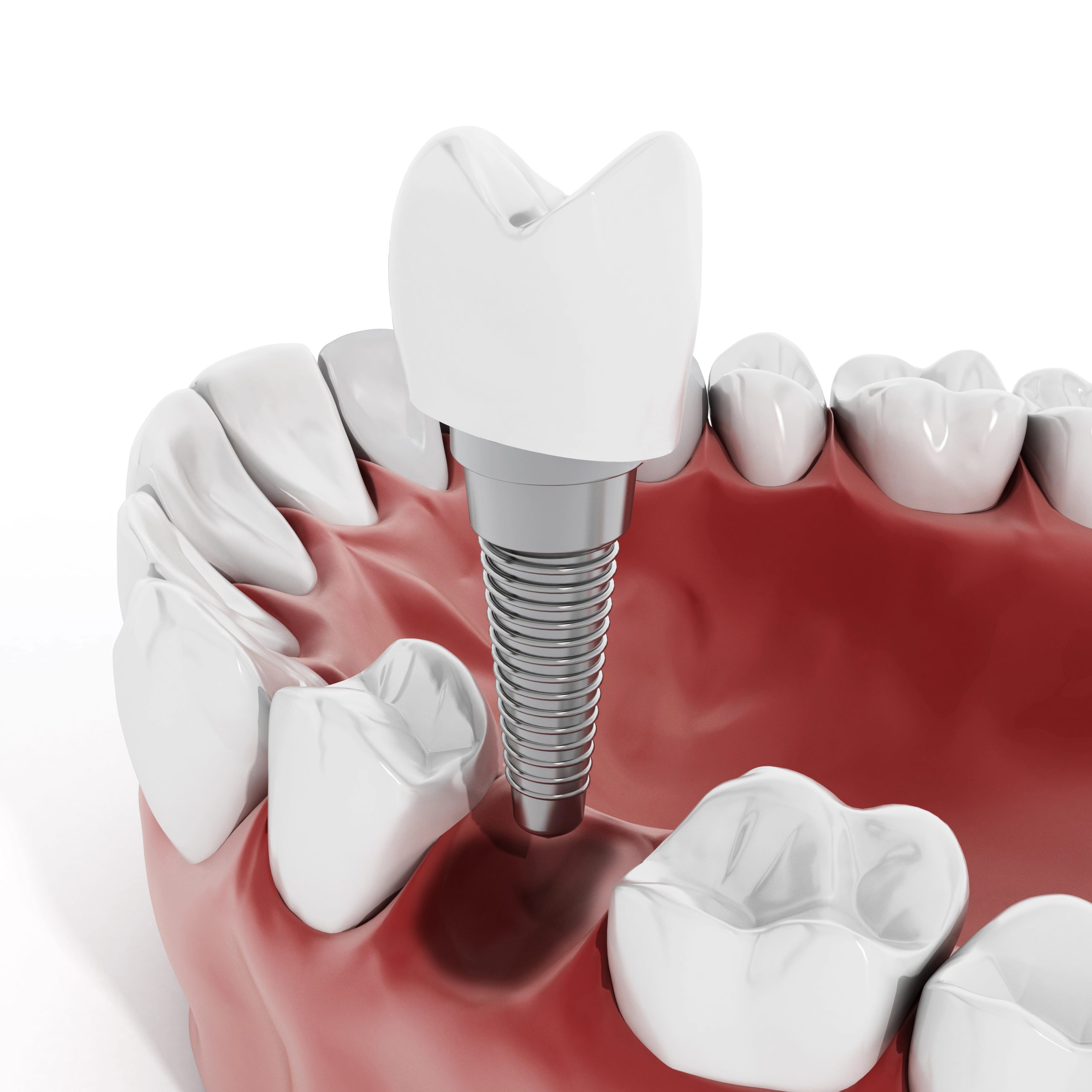 Full Mouth All on 4 Implants Candidates: Who Qualifies for Treatment